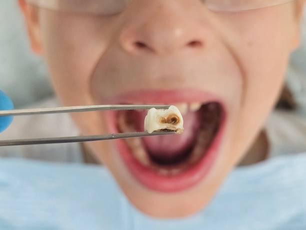 Best Dental Abscess Treatment in Kendall, FL